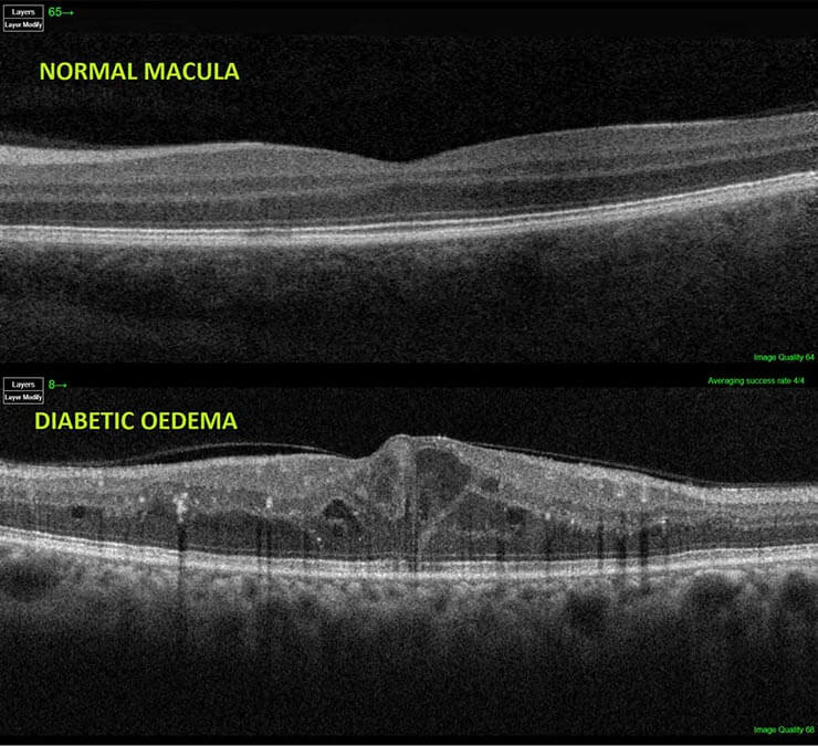 The scan results of an OCT scan, an eye test completed for diabetes customers.